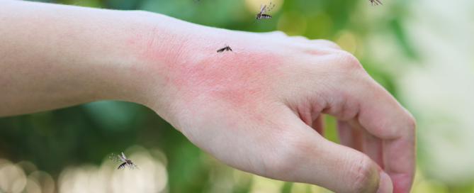 mosquito bite